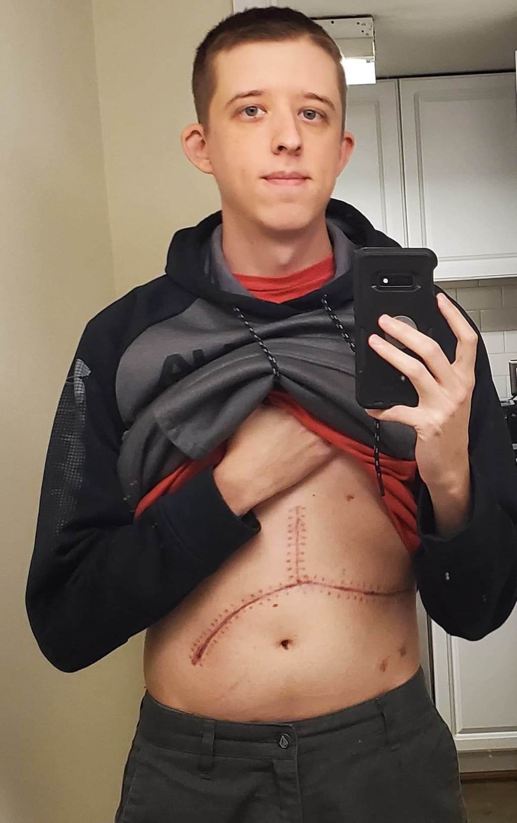 An Uncommon Diagnosis: Richmond Man’s Case Highlights Medical Issue